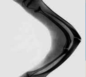 защита от переломов