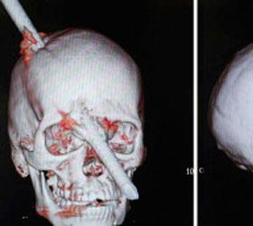 Бразилец смог выжить с пробитой насквозь головой