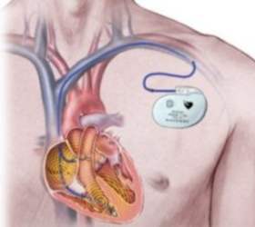  Имплантируемый кардиостимулятор можно заставить убить пациента удаленно