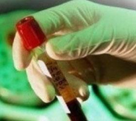 При помощи ВИЧ девочку вылечили от рака